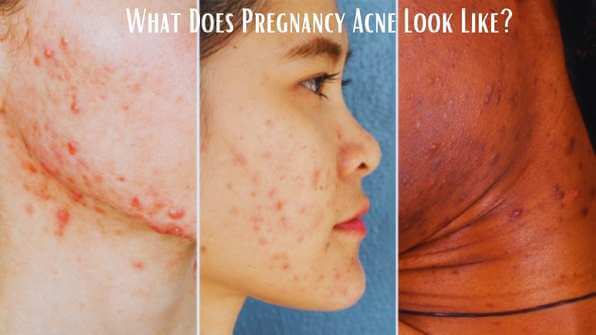 What does pregnancy acne look like