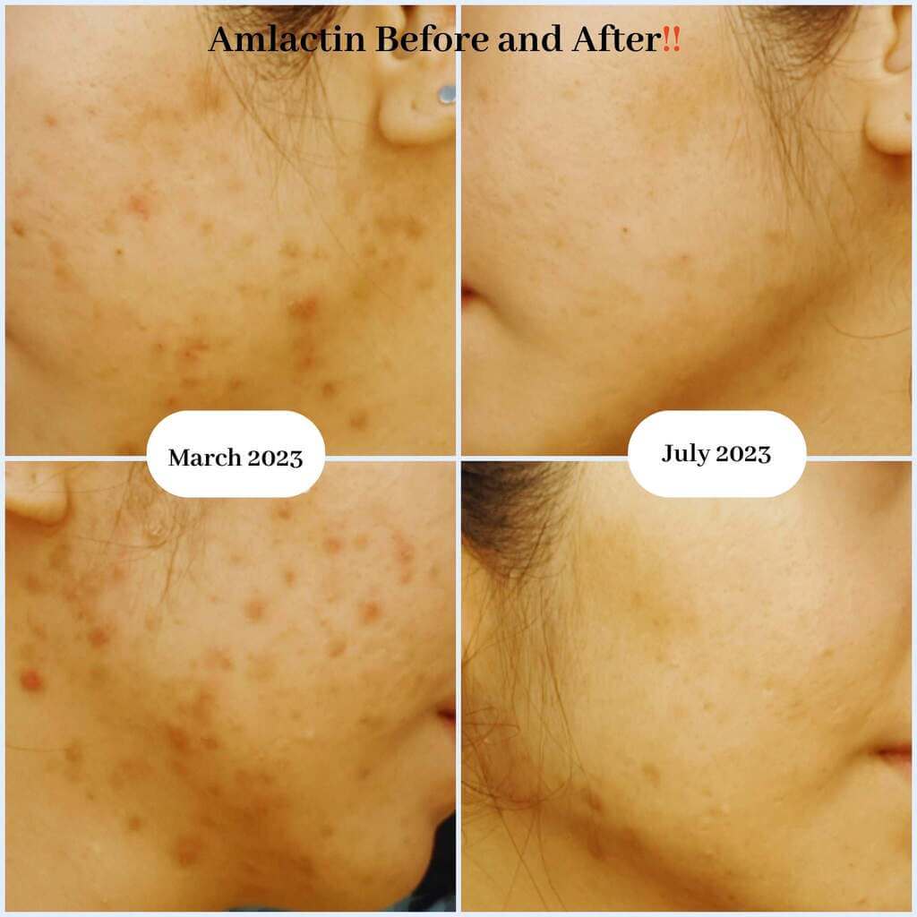 amlactin before and after