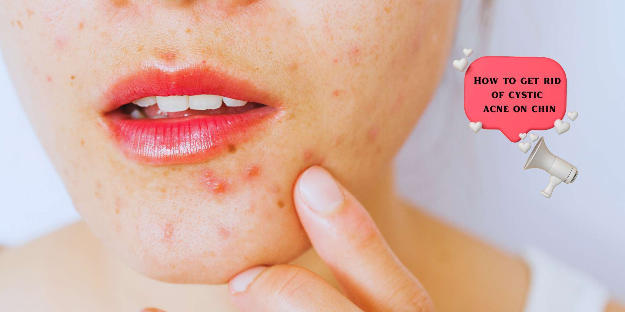 How to get rid of cystic acne on chin