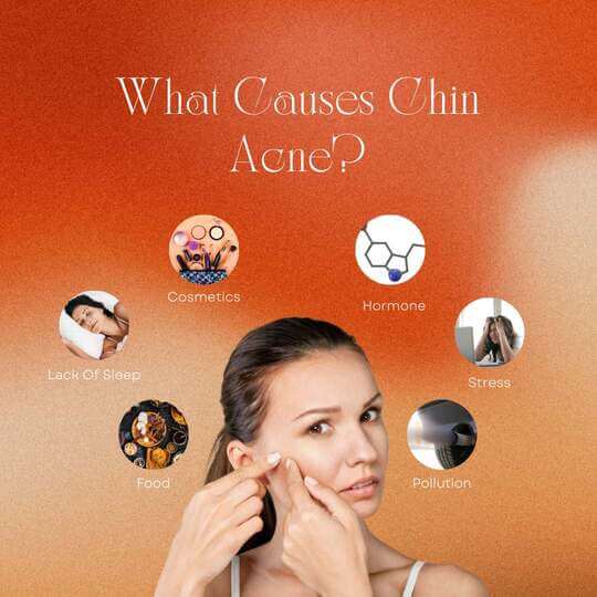 what causes chin acne