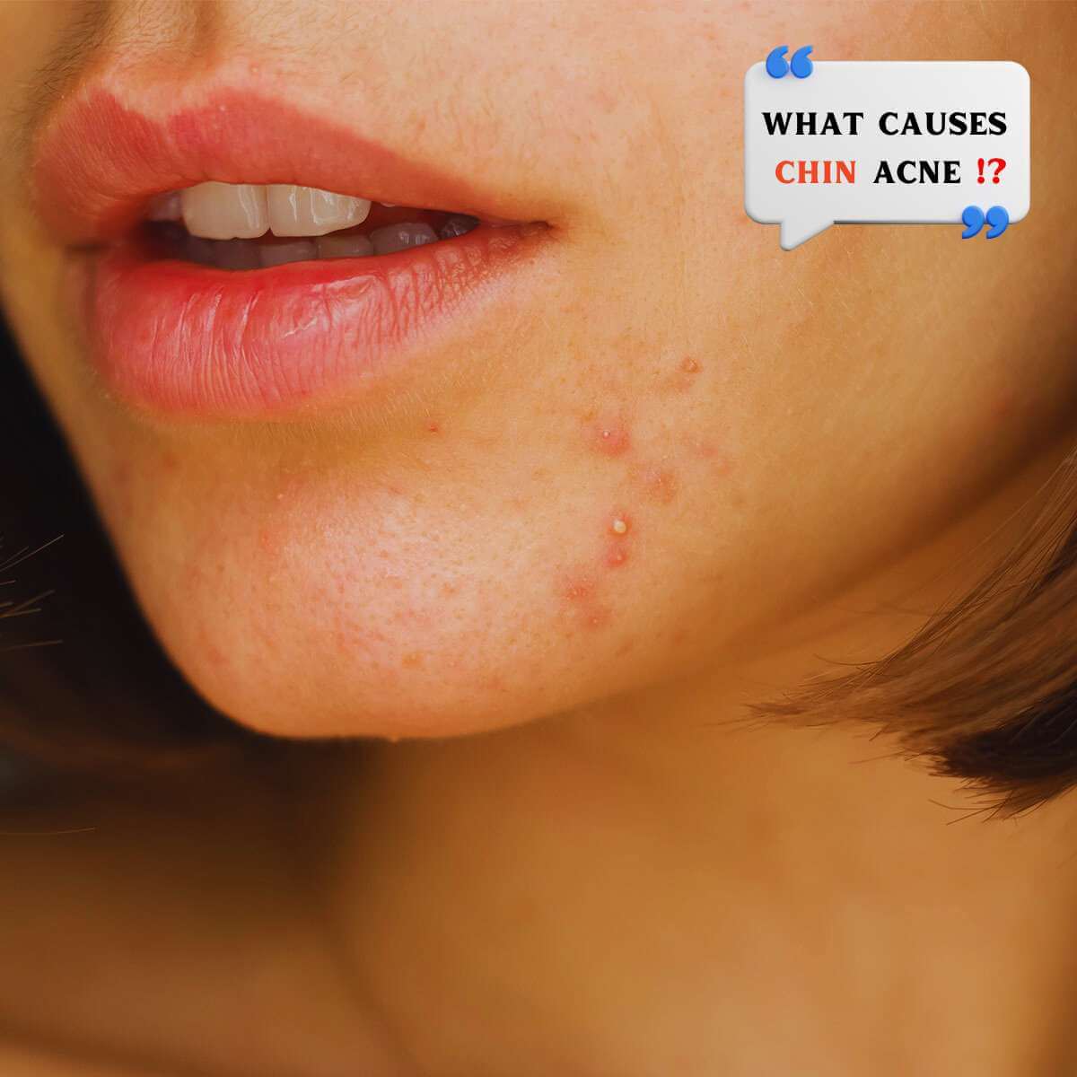 what causes chin acne