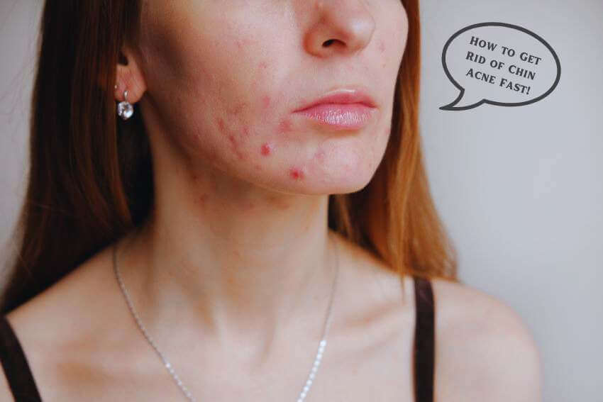 How to get rid of chin acne