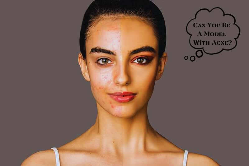 Can you be a model with acne?